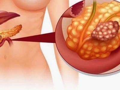 Bệnh tụy có nguy hiểm không? Những điều cần biết