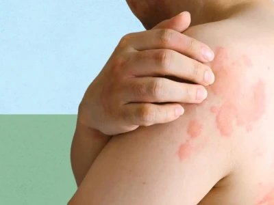 Hình ảnh bệnh phong ngứa và những điều cần biết