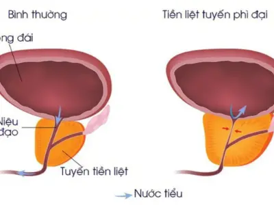 Nguyên nhân bệnh tiền liệt tuyến: Hiểu rõ để phòng tránh hiệu quả