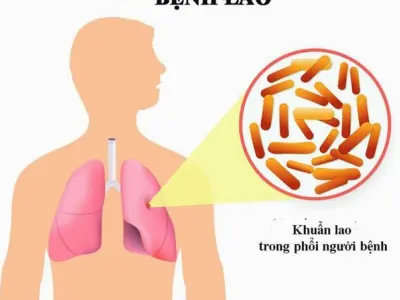 Triệu chứng bệnh lao phổi: Nhận biết sớm để điều trị kịp thời