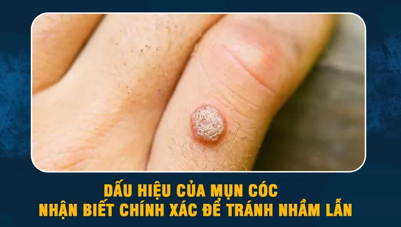 Bệnh mụn cóc là gì? nhận biết qua hình ảnh để điều trị 
 7