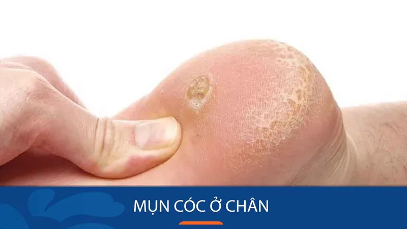 Bệnh mụn cóc là gì? nhận biết qua hình ảnh để điều trị 
 15