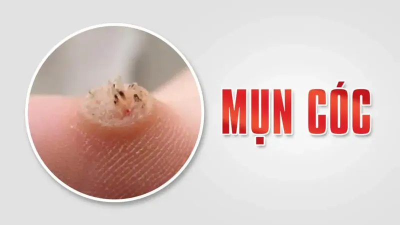 Bệnh mụn cóc là gì? nhận biết qua hình ảnh để điều trị 
 21