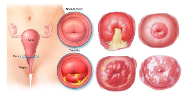 Cảnh báo, nhận biết viêm âm đạo do vi khuẩn qua hình ảnh
 4