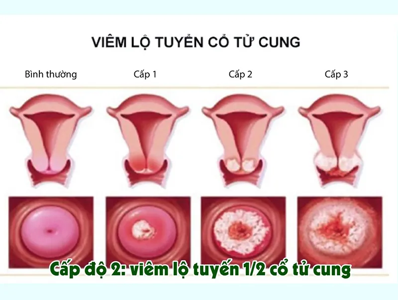 Cảnh báo, nhận biết viêm âm đạo do vi khuẩn qua hình ảnh
 6