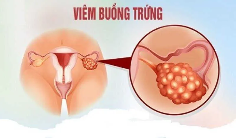 Cảnh báo, nhận biết viêm âm đạo do vi khuẩn qua hình ảnh
 7