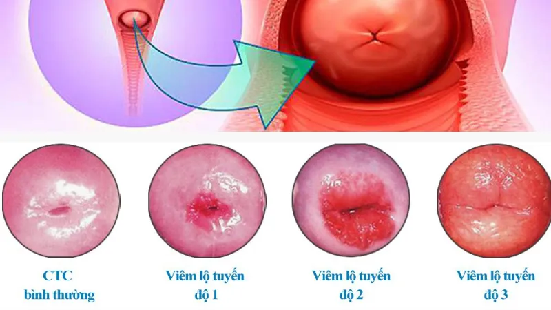 Cảnh báo, nhận biết viêm âm đạo do vi khuẩn qua hình ảnh
 8