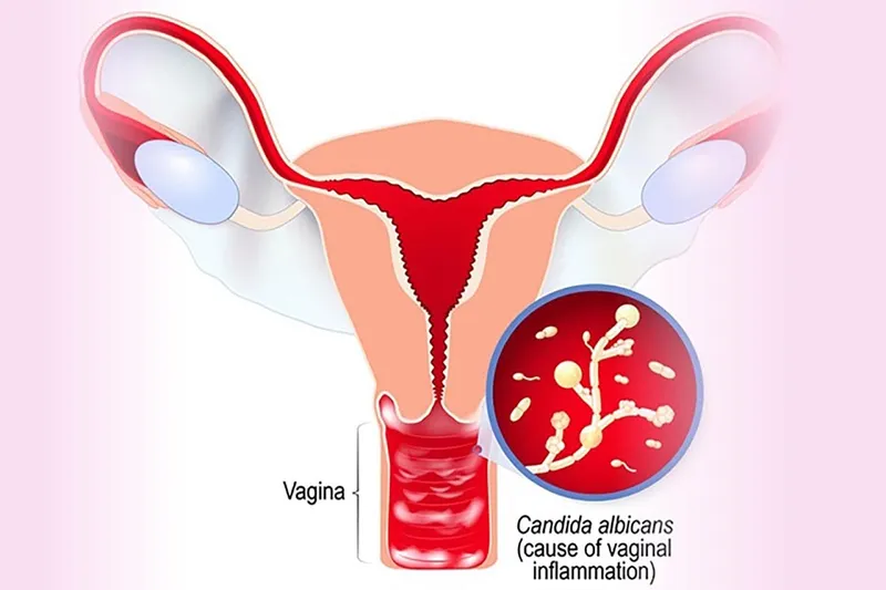 Cảnh báo, nhận biết viêm âm đạo do vi khuẩn qua hình ảnh
 10