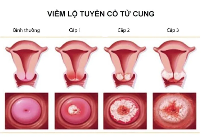 Cảnh báo, nhận biết viêm âm đạo do vi khuẩn qua hình ảnh
 11