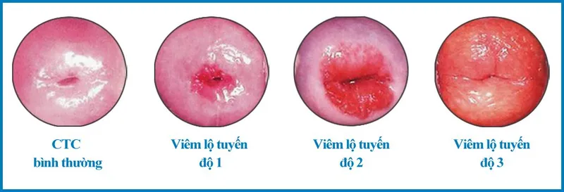 Cảnh báo, nhận biết viêm âm đạo do vi khuẩn qua hình ảnh
 14