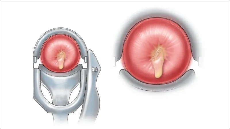 Cảnh báo, nhận biết viêm âm đạo do vi khuẩn qua hình ảnh
 17