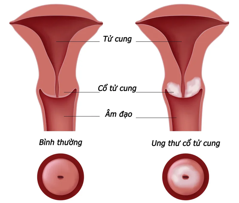 Cảnh báo, nhận biết viêm âm đạo do vi khuẩn qua hình ảnh
 21