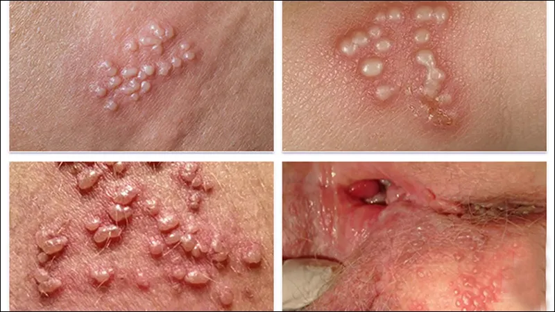  Top 98+ Hình ảnh Herpes, nhận biết sớm để điều trị hiệu quả
 15