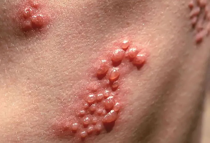 Top 98+ Hình ảnh Herpes, nhận biết sớm để điều trị hiệu quả
 19