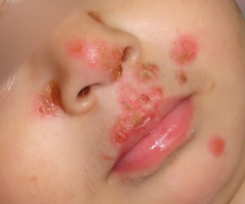 Top 98+ Hình ảnh Herpes, nhận biết sớm để điều trị hiệu quả
 20