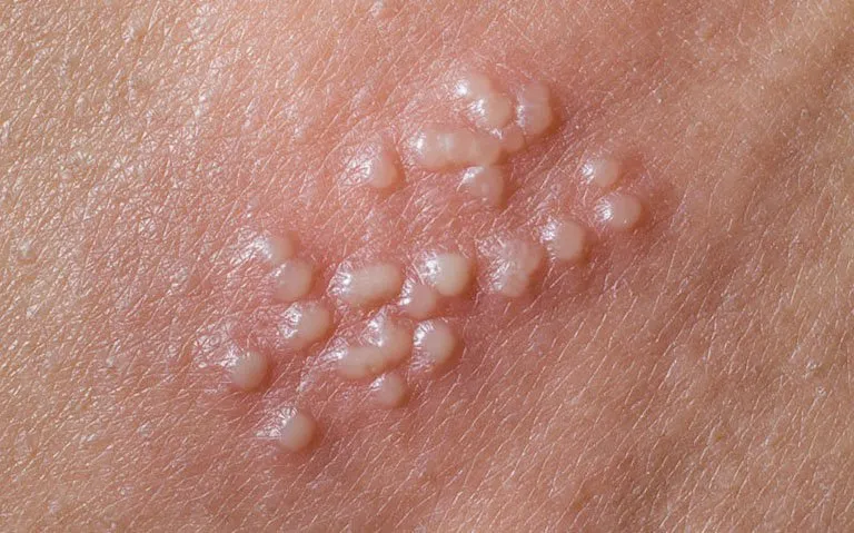 Top 98+ Hình ảnh Herpes, nhận biết sớm để điều trị hiệu quả
 23