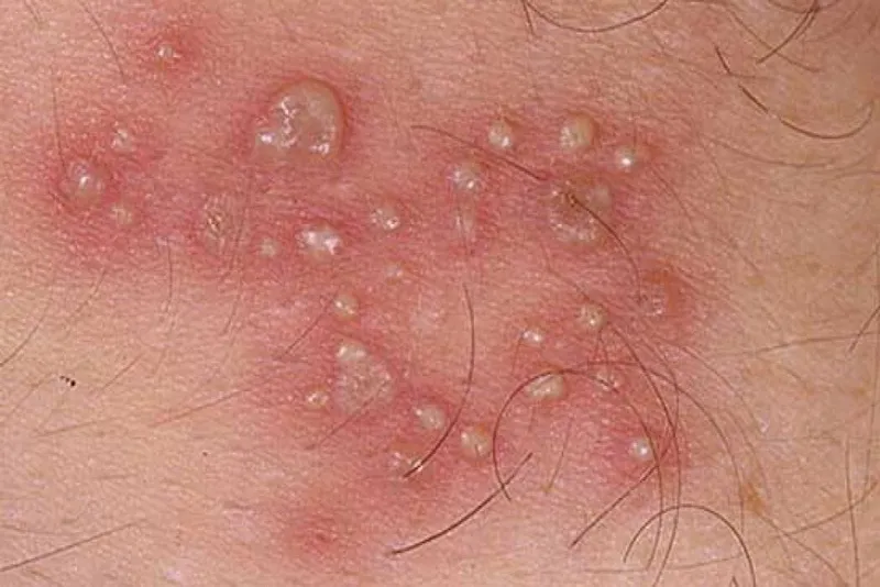 Top 98+ Hình ảnh Herpes, nhận biết sớm để điều trị hiệu quả
 29