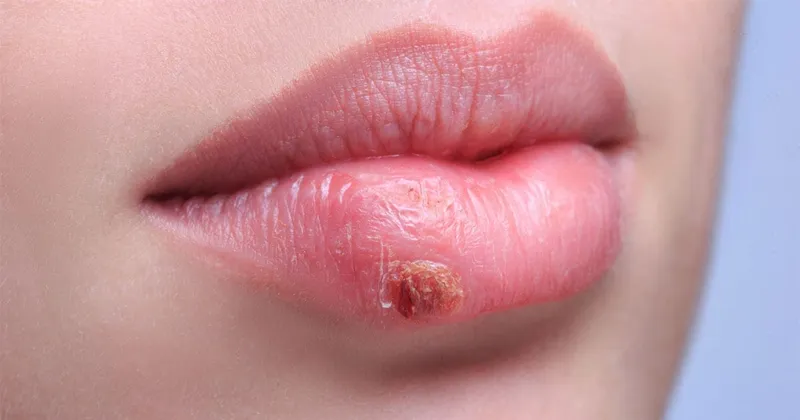 Top 98+ Hình ảnh Herpes, nhận biết sớm để điều trị hiệu quả
 34