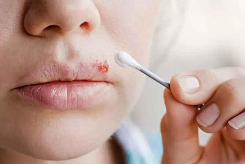 Top 98+ Hình ảnh Herpes, nhận biết sớm để điều trị hiệu quả
 35