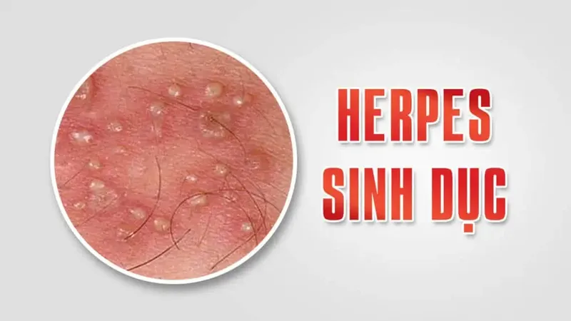 Top 98+ Hình ảnh Herpes, nhận biết sớm để điều trị hiệu quả
 1