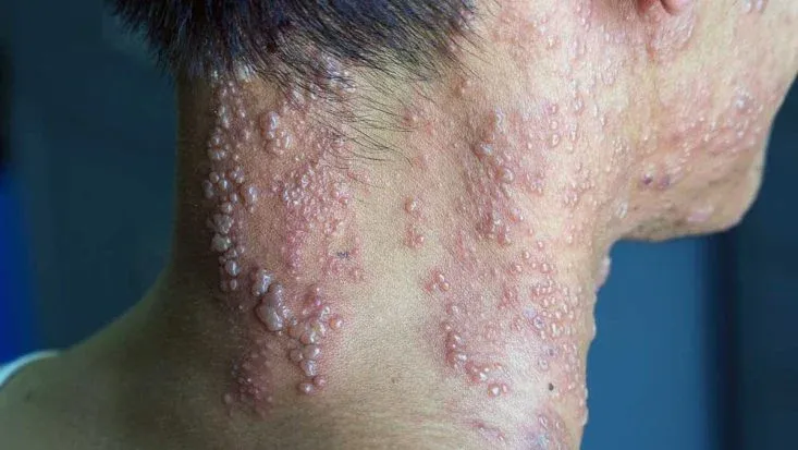 Top 98+ Hình ảnh Herpes, nhận biết sớm để điều trị hiệu quả
 2