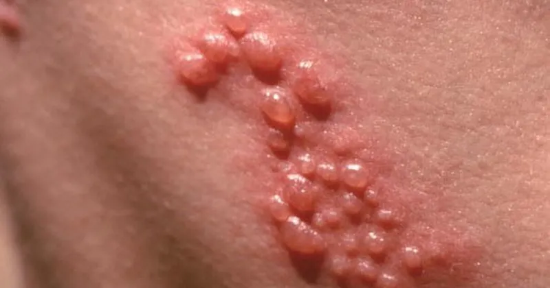 Top 98+ Hình ảnh Herpes, nhận biết sớm để điều trị hiệu quả
 6