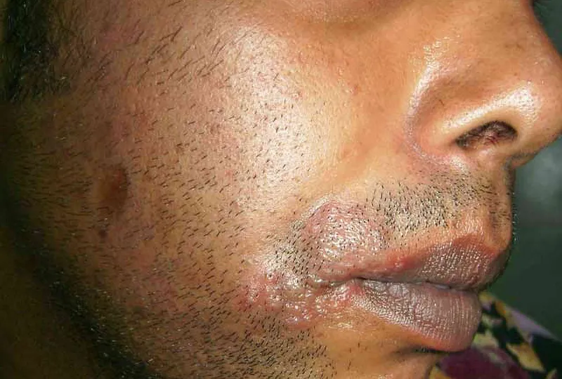 Top 98+ Hình ảnh Herpes, nhận biết sớm để điều trị hiệu quả
 10