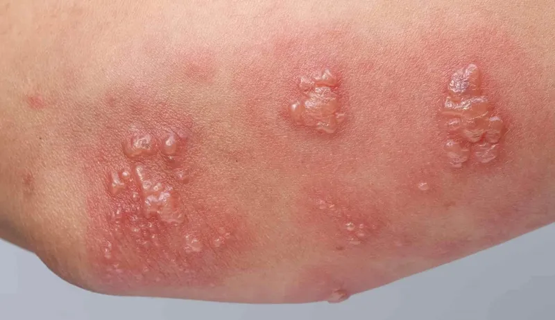 Top 98+ Hình ảnh Herpes, nhận biết sớm để điều trị hiệu quả
 12