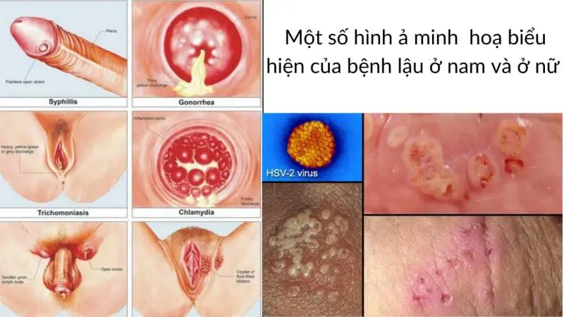 Hình ảnh bệnh lậu ở Nam 14